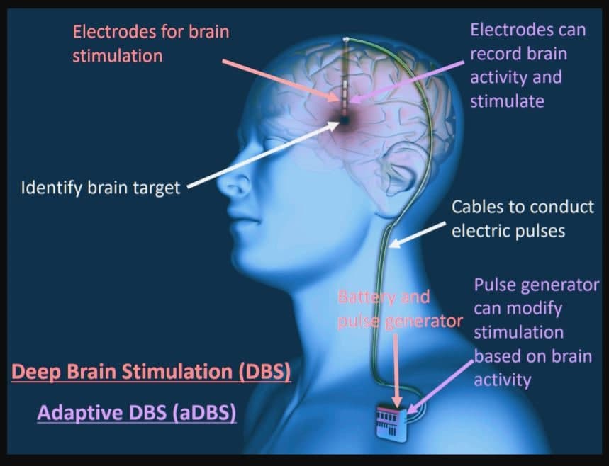 Brain Stimulator